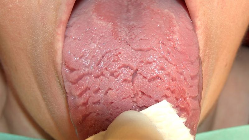 Lưỡi bị nứt có các khe nứt sâu chạy ngang, xen kẽ giữa vùng đỏ và mảng hồng nhạt