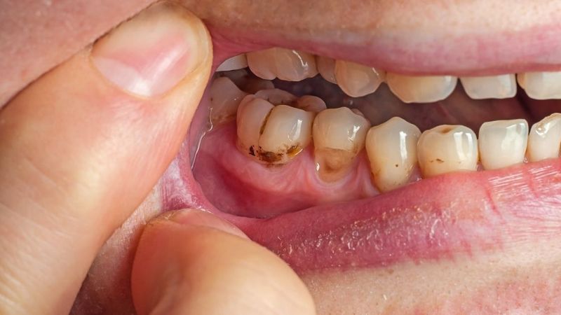 Răng miệng không được vệ sinh sạch sẽ cũng thúc đẩy nguy cơ bị nứt lưỡi