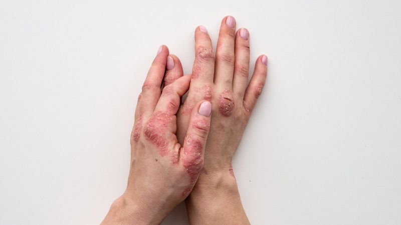 Những người bị bệnh vảy nến thường xuyên gặp tình trạng này