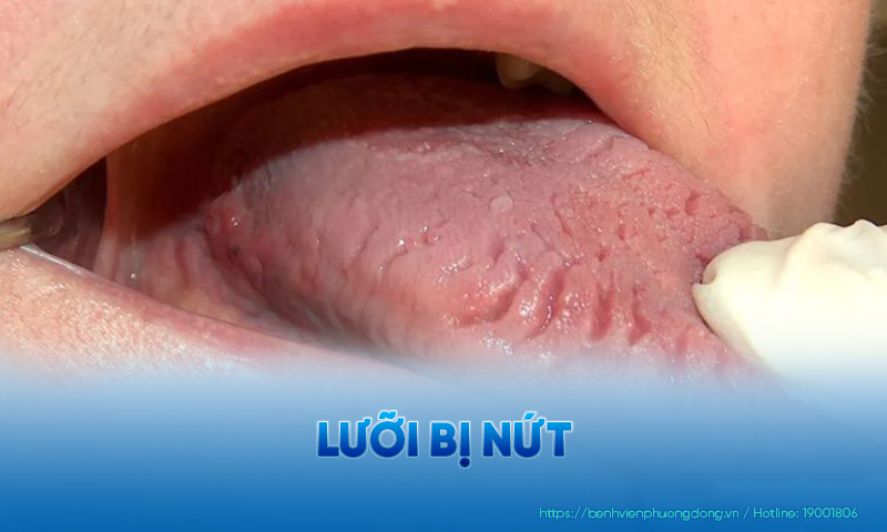 Lưỡi bị nứt phản ánh nhiều vấn đề về mặt sức khoẻ