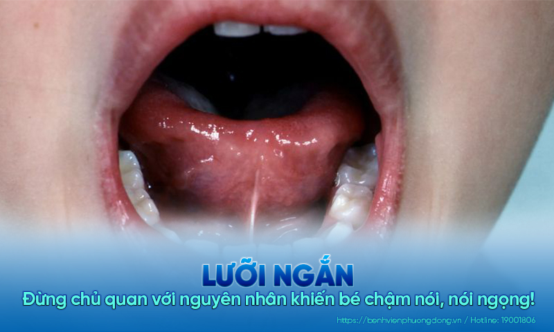 Đừng chủ quan với lưỡi ngắn - nguyên nhân khiến bé chậm nói!