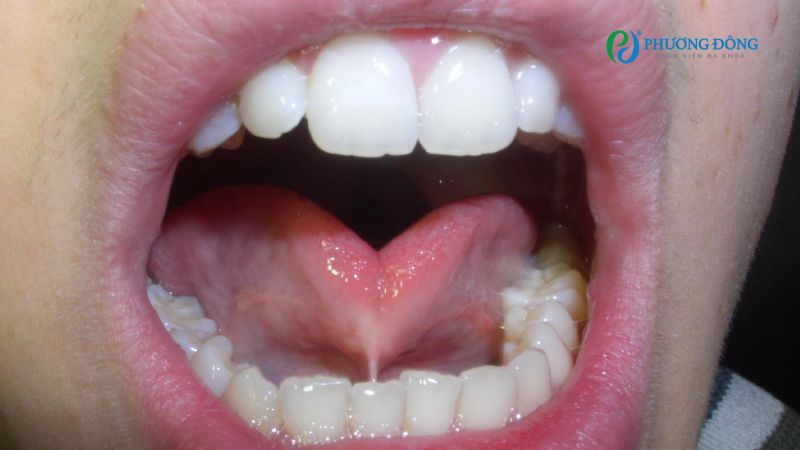 Đầu lưỡi hình trái tim là một trong số các triệu chứng điển hình của ngắn lưỡi