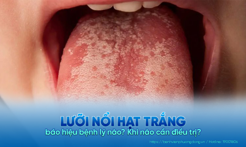Lưỡi nổi hột trắng báo hiệu bệnh lý nào? Khi nào cần điều trị?