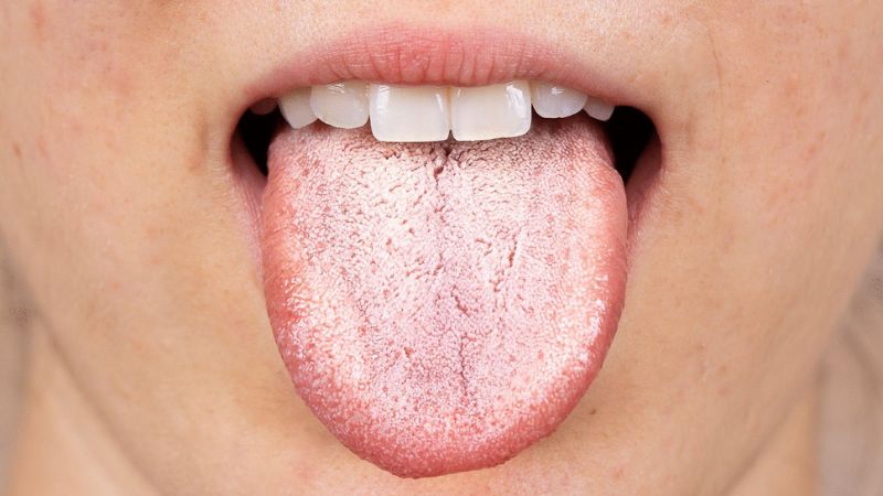 Nấm Candida là nguyên nhân hàng đầu gây ra tình trạng lưỡi nổi mụn trắng
