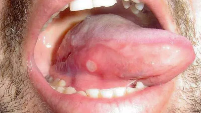 Nhiệt miệng cũng có thể gây ra các nốt trắng trên hoặc dưới bề mặt lưỡi