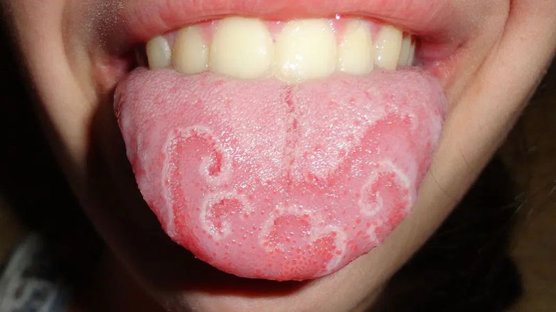 Viêm lưỡi bản đồ khiến lưỡi xuất hiện các mảng đỏ trắng