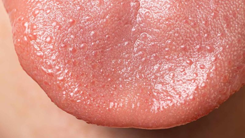 Minh hoạ lưỡi của bệnh nhân bị viêm gai