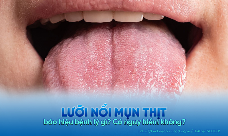 Lưỡi nổi mụn thịt báo hiệu bệnh lý gì? Có nguy hiểm không? 