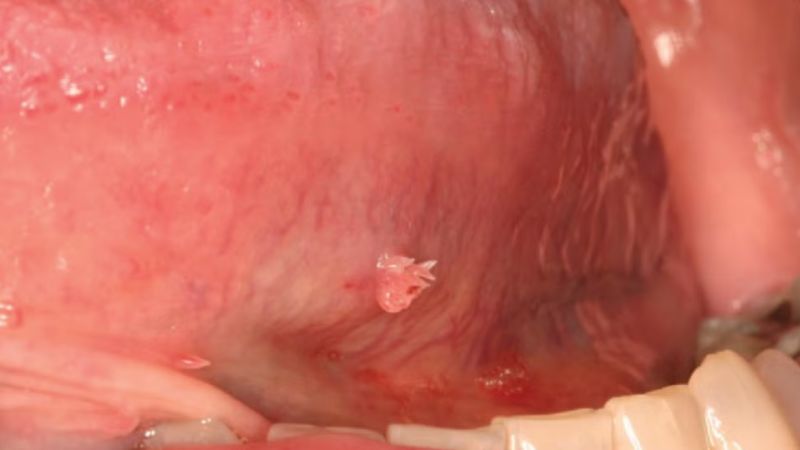 Nốt sùi mào gà trên lưỡi