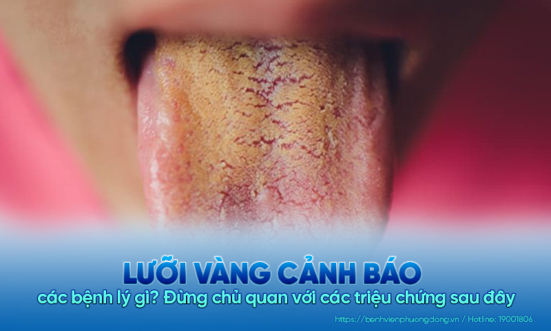 Bạn có chắc: Lưỡi vàng là triệu chứng không cần điều trị?