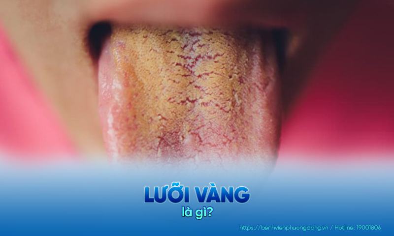 Lưỡi chuyển sang màu vàng ẩn chứa nhiều bất thường về mặt sức khoẻ