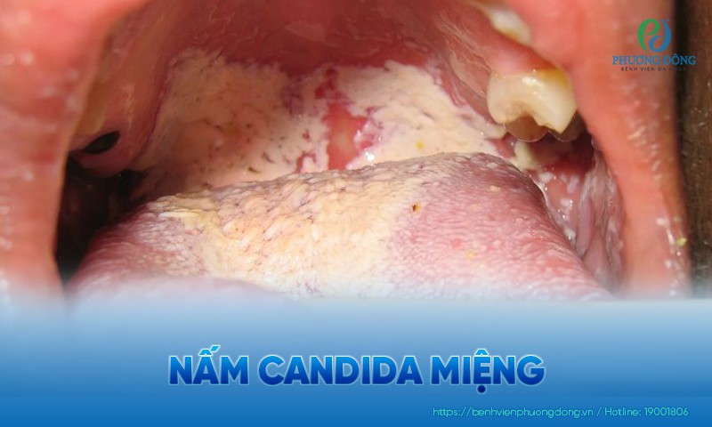 Nấm candida miệng: Nguyên nhân, triệu chứng và điều trị