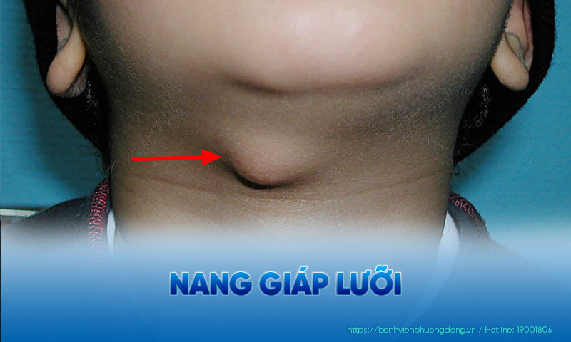 Nang giáp lưỡi gặp thường xuất hiện ở ống giáp lưỡi, di chuyển theo chuyển động nhai nuốt