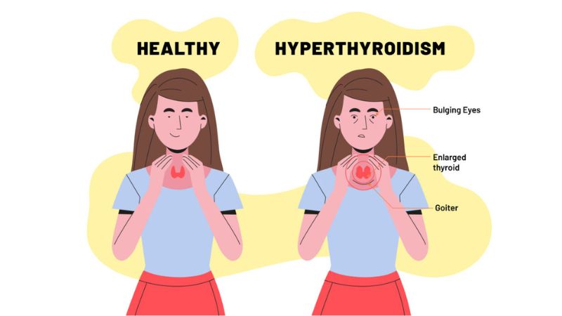 Một trong các biến chứng của bất thường này là suy giáp