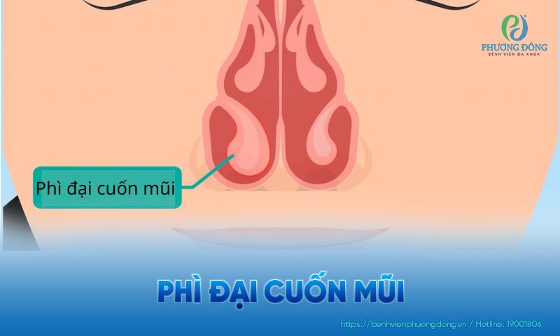 Phì đại cuốn mũi: Triệu chứng, nguyên nhân và hướng điều trị