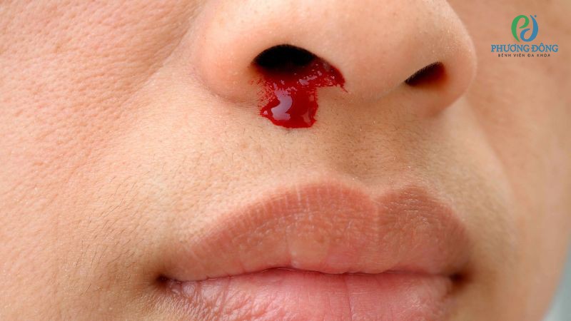 Các biến chứng quá phát cuốn mũi cần thận trọng