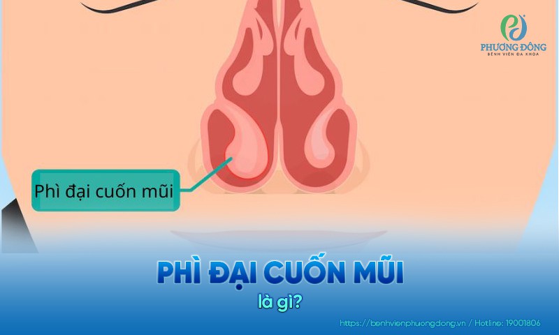 Phì đại cuốn mũi là tình trạng các mô cuốn mũi phát triển quá mức, to bất thường