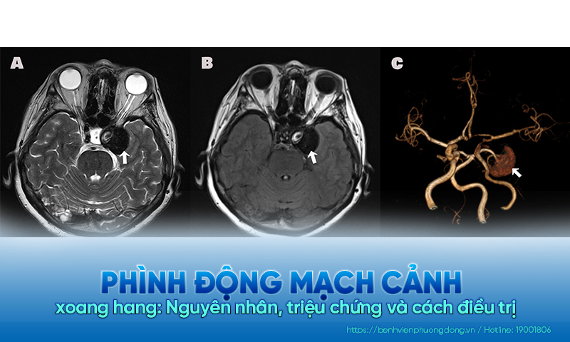 Phình động mạch cảnh xoang hang: Nguyên nhân, triệu chứng và cách điều trị