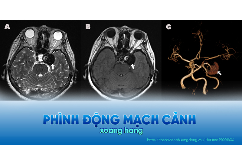 Minh hoạ phình động mạch trên phim chụp MRI