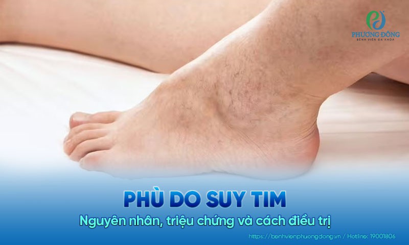 Phù do suy tim: Nguyên nhân, triệu chứng và cách điều trị