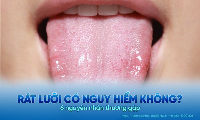 Rát lưỡi có nguy hiểm không? 6 nguyên nhân thường gặp