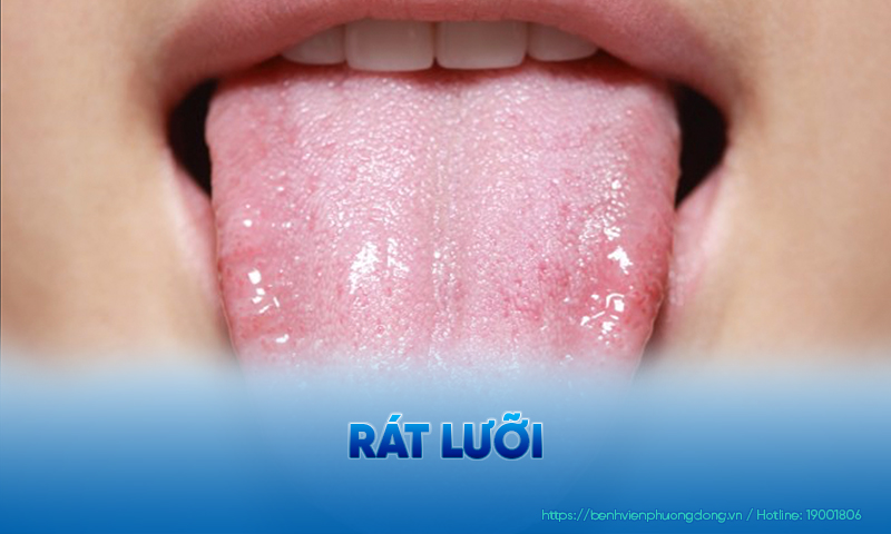 Rát lưỡi báo hiệu nhiều tình trạng sức khoẻ bất thường