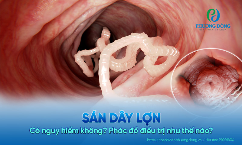 Sán dây lợn có nguy hiểm không? Phác đồ điều trị như thế nào?