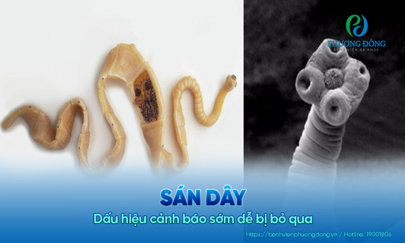 Sán dây và 8 dấu hiệu cảnh báo sớm dễ bị bỏ qua