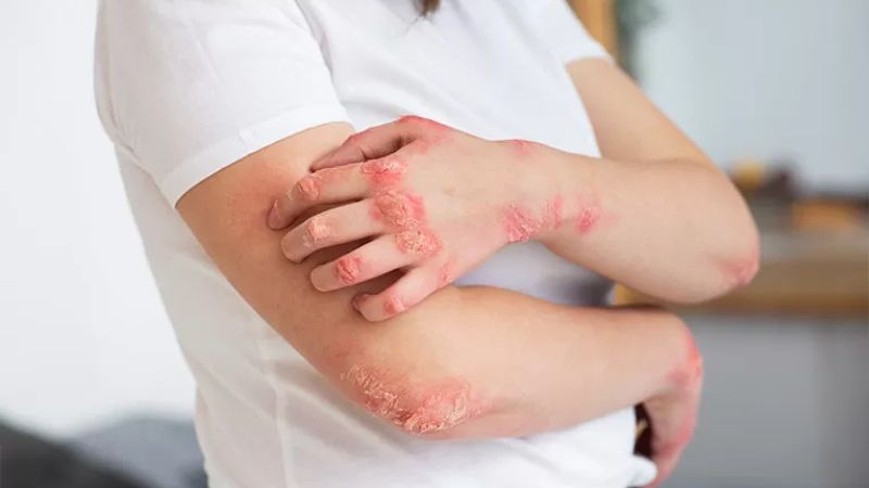 Lupus ban đỏ hệ thống cũng có thể gây ra các triệu chứng bất thường ở lưỡi