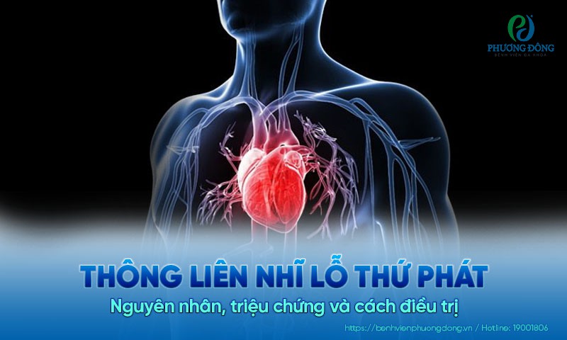 Thông liên nhĩ lỗ thứ phát là gì? Nguyên nhân và triệu chứng của bệnh