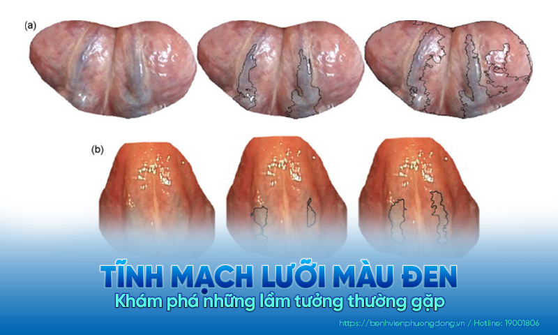 Khám phá những lầm tưởng về tĩnh mạch dưới lưỡi màu đen