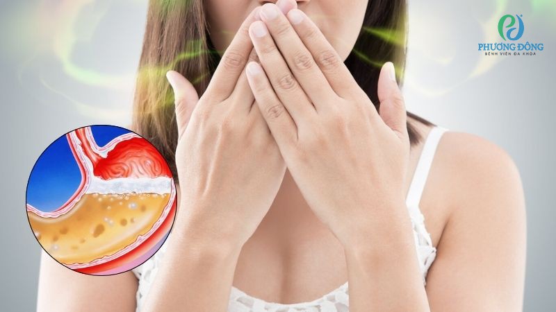 Hở van dạ dày khiến mùi thức ăn trào lên qua thực quản