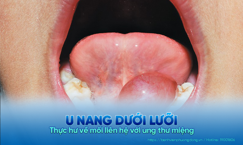Thực hư về mối liên hệ giữa u nang dưới lưỡi và ung thư miệng