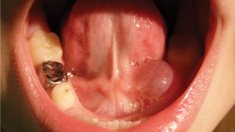 Các nang nhỏ dưới lưỡi có thể biến mất mà không cần điều trị