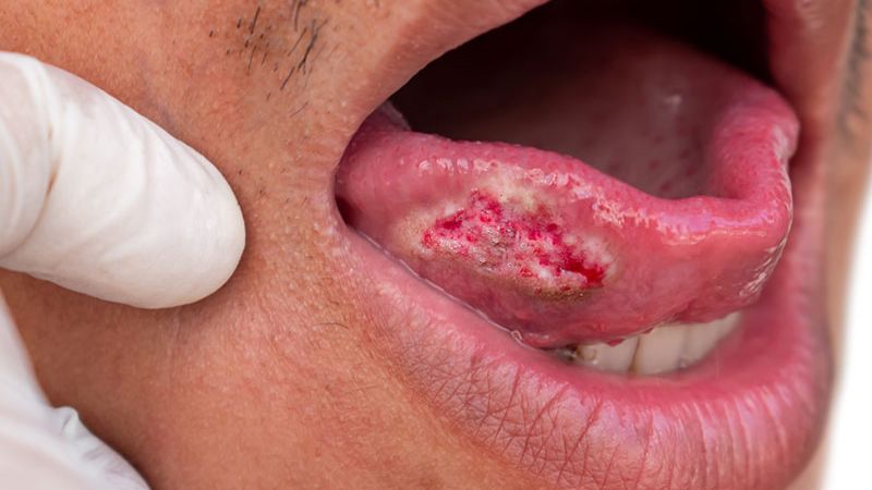 Trong trường hợp xấu nhất, bệnh có thể diễn biến thành ung thư miệng