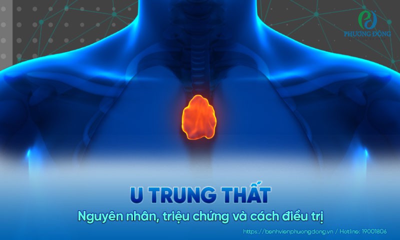 U trung thất: Nguyên nhân, triệu chứng và cách điều trị