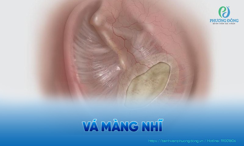Vá màng nhĩ: Phương pháp phẫu thuật và quy trình thực hiện