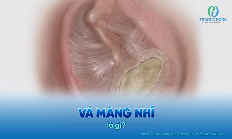 Vá màng nhĩ là thủ thuật sửa chữa khi màng tai bị rách hoặc thủng