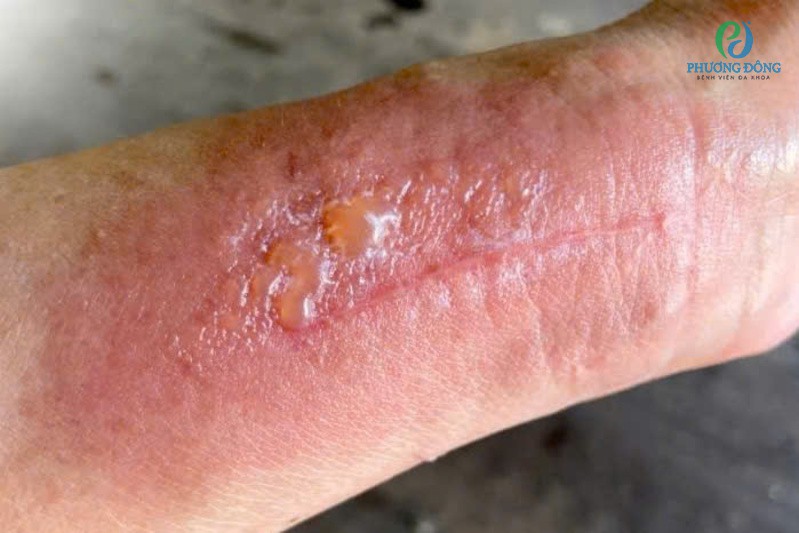 Viêm da tiếp xúc do nắng và mồ hôi 