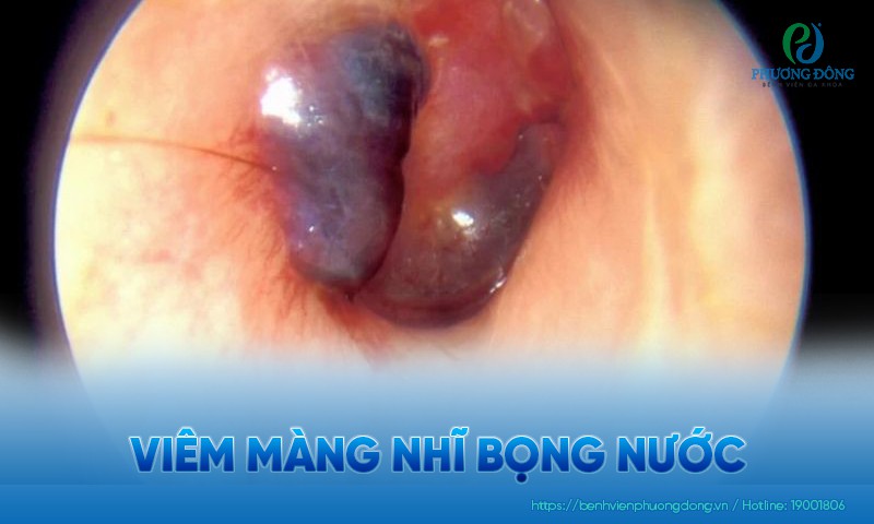 Viêm màng nhĩ bọng nước: Triệu chứng, nguyên nhân và điều trị