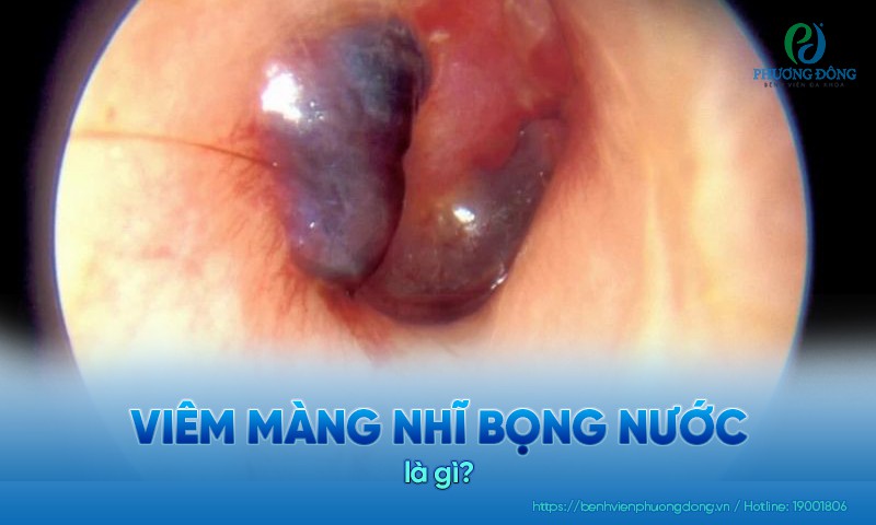 Viêm màng nhĩ bọng nước là một dạng nhiễm trùng tai