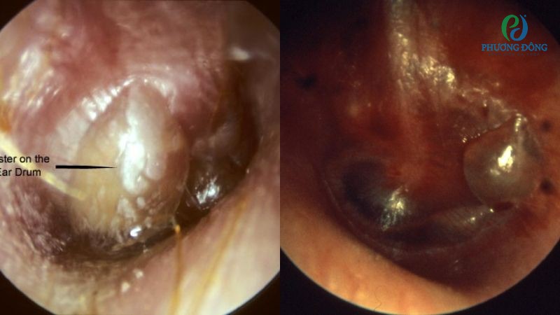 Triệu chứng viêm màng nhĩ bọng nước thường giống với viêm tai