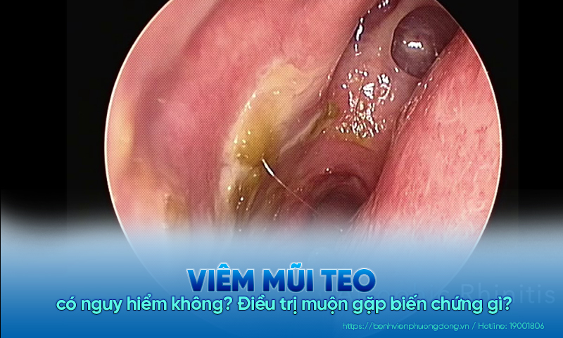 Viêm mũi teo có nguy hiểm không? Điều trị muộn gặp biến chứng gì?