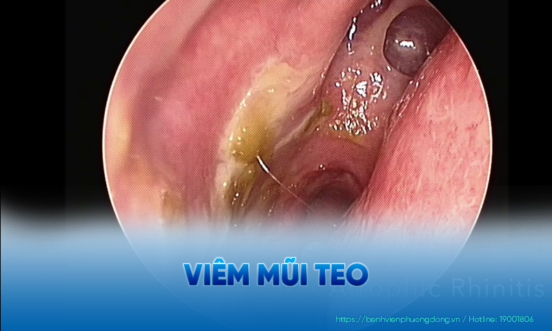 Minh hoạ viêm mũi teo trên nội soi