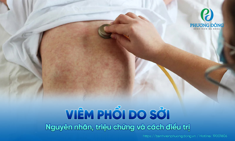 Viêm phổi do sởi là gì? Nguyên nhân, triệu chứng và cách điều trị