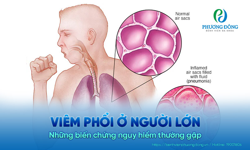 Viêm phổi ở người lớn: Những biến chứng nguy hiểm thường gặp