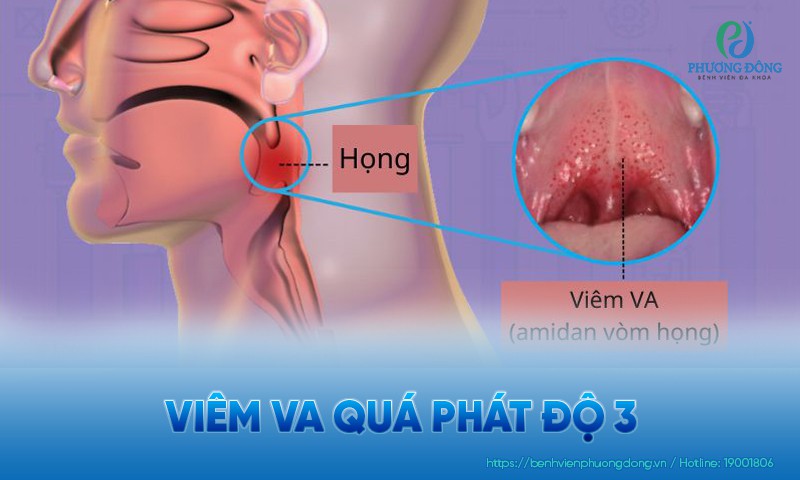 Viêm VA quá phát độ 3: Biểu hiện, biến chứng và hướng điều trị