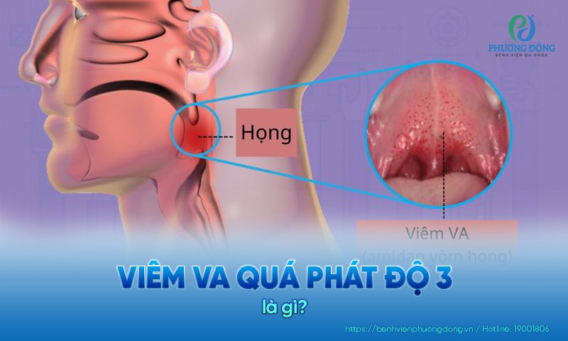 Viêm VA quá phát độ 3 là tình trạng VA phì đại chèn ép 75% cửa mũi sau