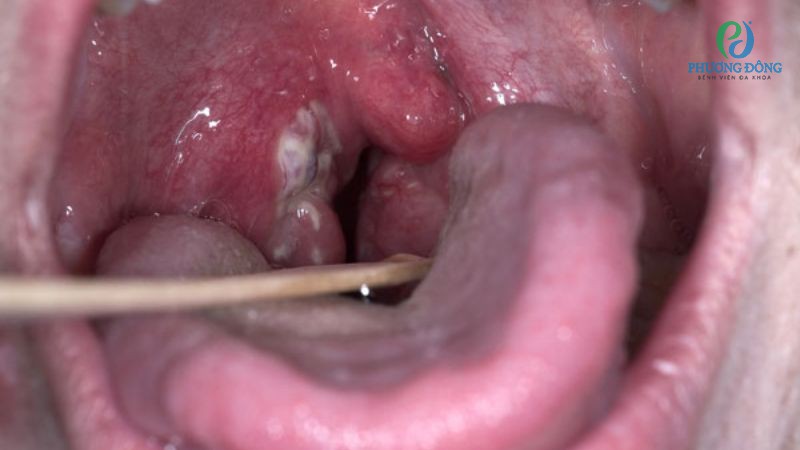 Biểu hiện lâm sàng viêm VA phì đại độ 3