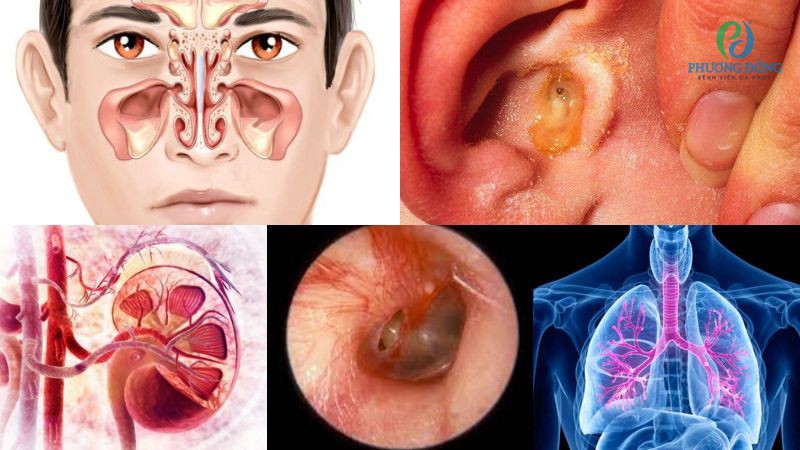 Cần thận trọng với những biến chứng viêm VA quá phát độ 3